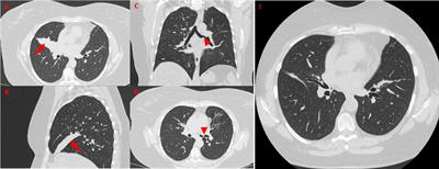 Case Report: Middle lobe syndrome: a rare presentation in eosinophilic granulomatosis with polyangiitis